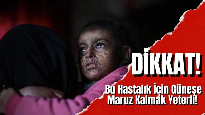Duyunca Şaşıracaksınız: Bu Hastalık İçin Güneşe Sadece Dakikalarca Maruz Kalmak Yeterli! Xeroderma Pigmentosum Nedir?