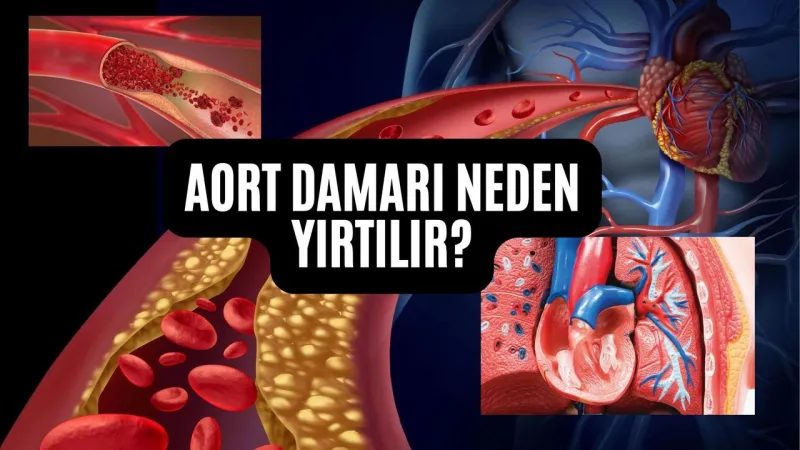 Aort Damarı Neden Yırtılır? Şok Eden Sebepler!